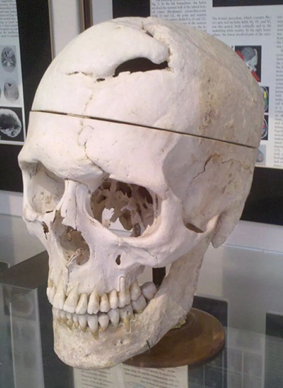zdjęcie czaszki phineasa gage która jest eksponatem w zbiorach w Warren Anatomical Museum na Uniwersytecie Harvarda